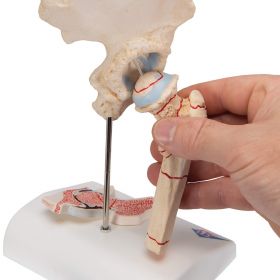 Femoral Fracture and Hip Osteoarthritis Model [Pack of 1]