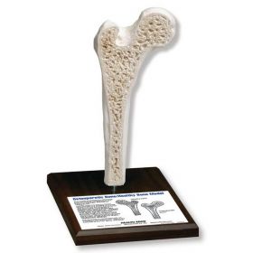 Osteoporosis Model [Pack of 1]