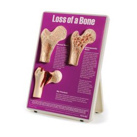 Loss of a Bone Easel Display [Pack of 1]