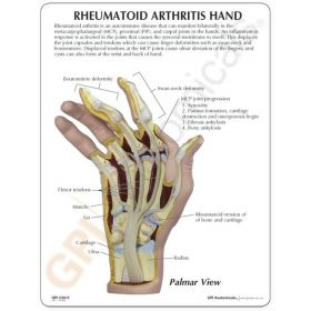 Rheumatoid Arthritis (RA) Hand Model [Pack of 1]