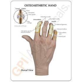 Osteoarthritis (OA) Hand Model [Pack of 1]