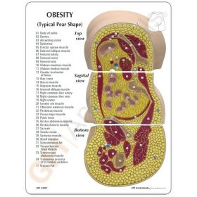 Obesity / Body Type Anatomy Model [Pack of 1]
