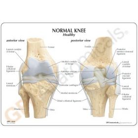 Osteoarthritis Knee Model Set (4 stages) [Pack of 1]