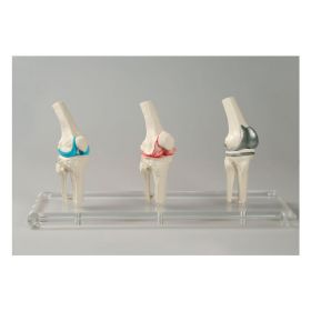 Knee Implant / Replacement Model Set (3 part) [Pack of 1]