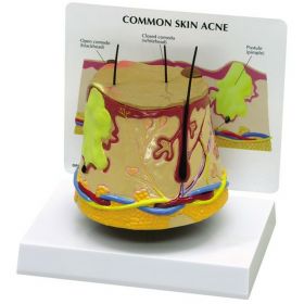Skin Acne Model [Pack of 1]