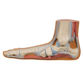 Flat Foot Model (Pes Planus) [Pack of 1]