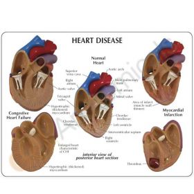 Heart Disease Model (3 part) [Pack of 1]