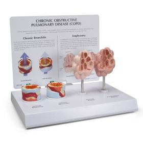 COPD Model (4 part) [Pack of 1]