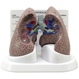 Diseased Lung Model (COPD, Cancer, Asthma) [Pack of 1]
